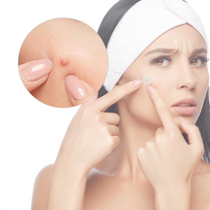 Acne Spot Patch
